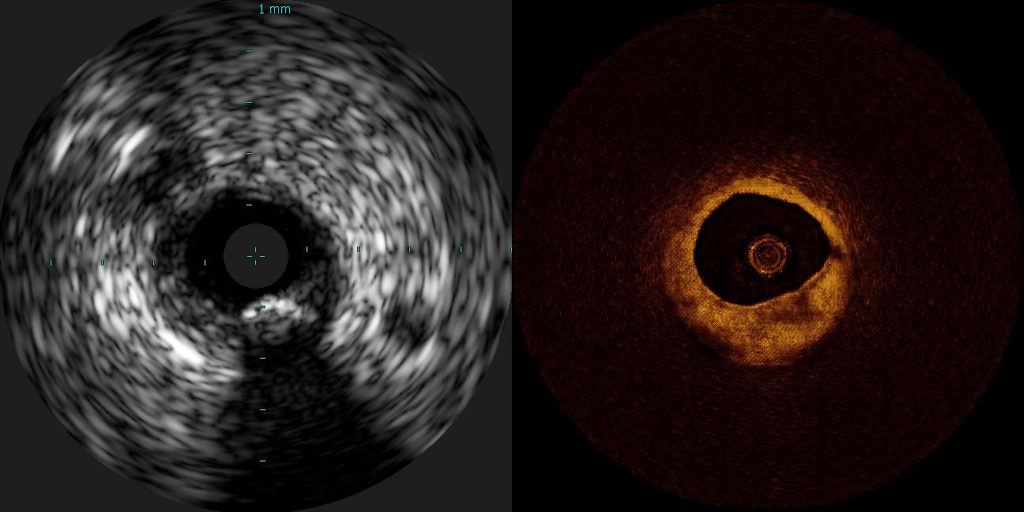AI in intravascular imaging