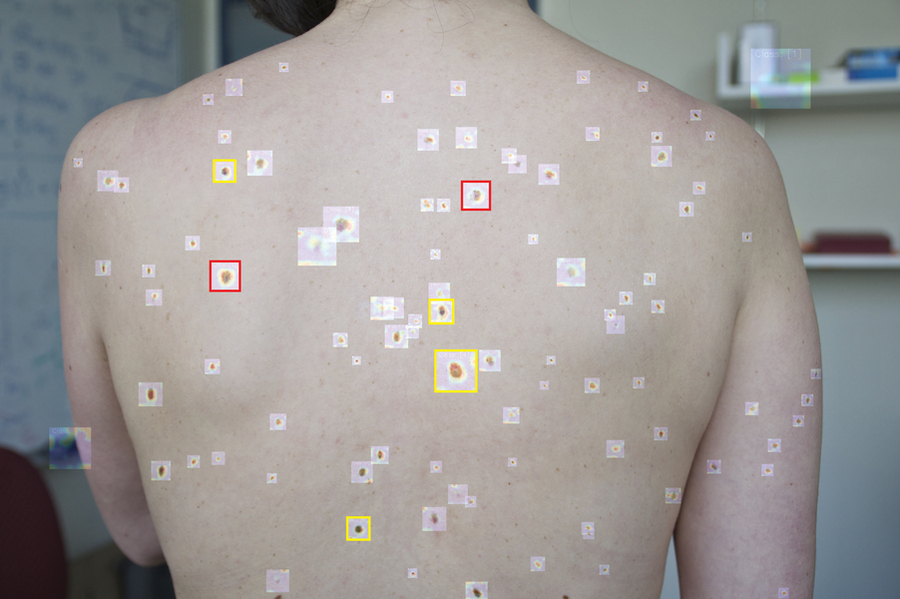 Melanoma research