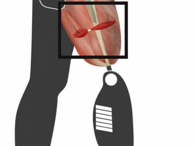 A surgical technique designed to preserve proprioceptive signals after amputation should allow patients to sense the location of their prostheses, feedback that is often compromised by convential surgery. Image courtesy of Shriya Srinivasan.