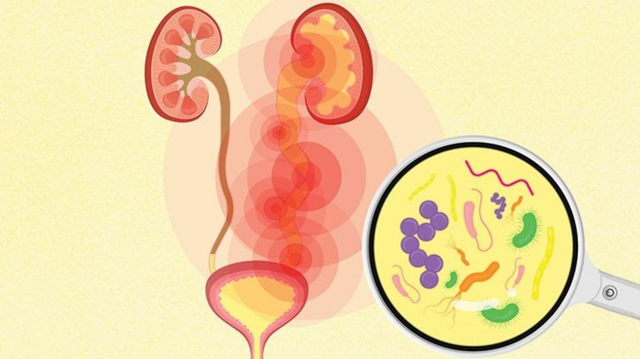 Algorithm reduces unnecessary use of antibiotics for UTIs