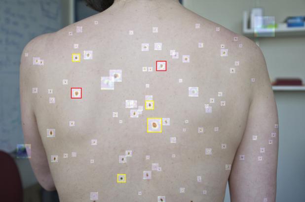 Melanoma research
