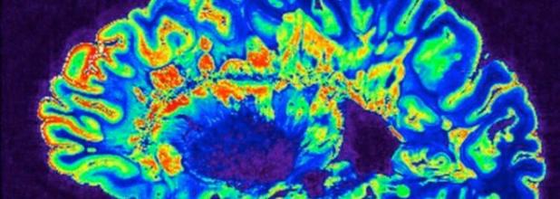 MRI brain scan