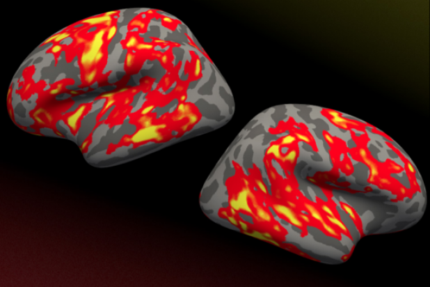 Brain regions that grew significantly thicker in reading-disabled children whose reading improved after an intensive summer treatment program, as shown in the red and yellow areas. Neither a control group nor children who did not respond to treatment exhibited changes in brain structure.” Image: Rachel Romeo