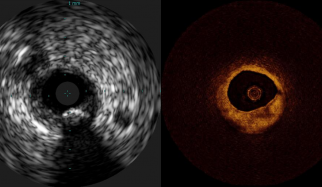 AI in intravascular imaging