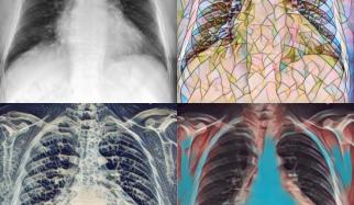 MIMIC-CXR-Image