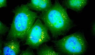 MIT researchers have designed inhalable particles that can deliver messenger RNA. These lung epithelial cells have taken up particles (yellow) that carry mRNA encoding green fluorescent protein. Image: Asha Patel